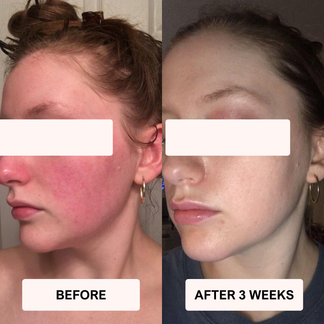 LUNA&SKIN RegenMask™
